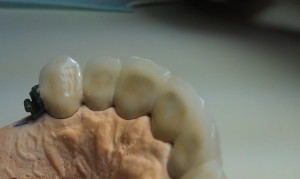 lucrare metalo ceramica 4