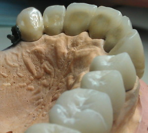 lucrare metalo ceramica 5